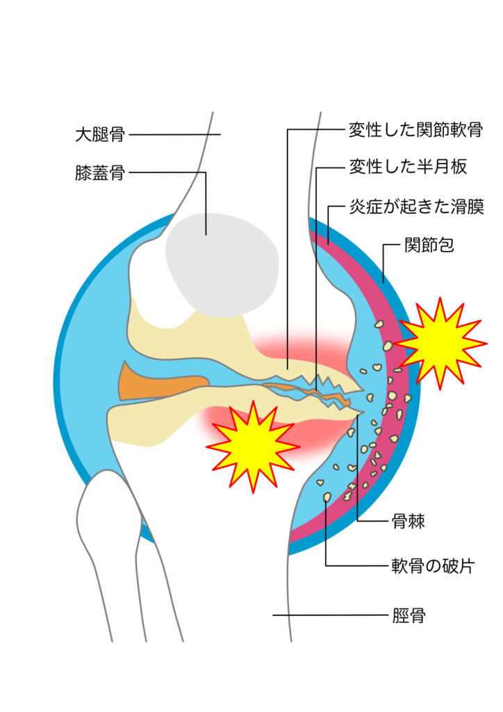 変形性膝関節症