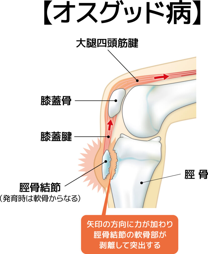 オスグッドの病態