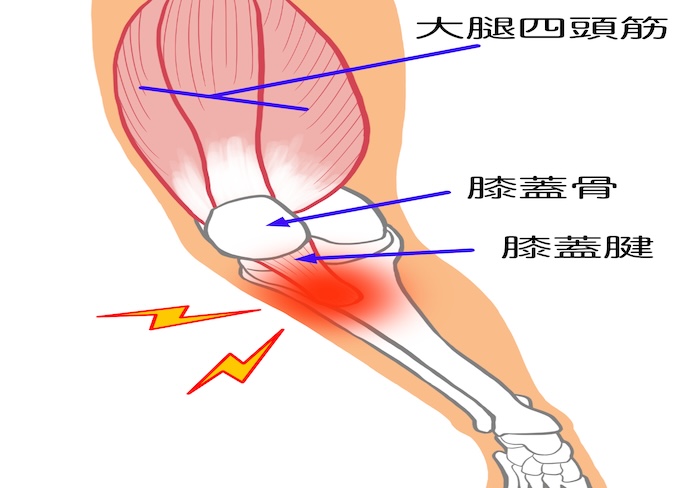 ジャンパー膝