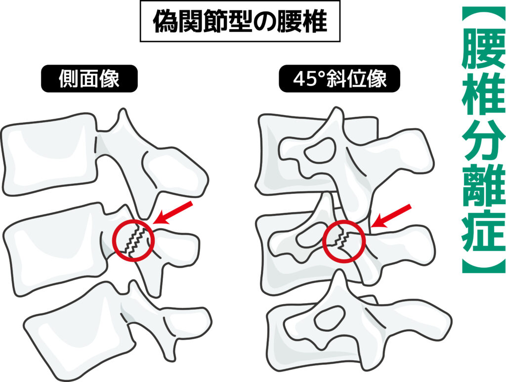 腰椎分離症の説明