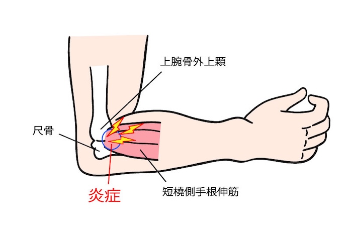 上腕骨外側上顆炎（テニス肘）