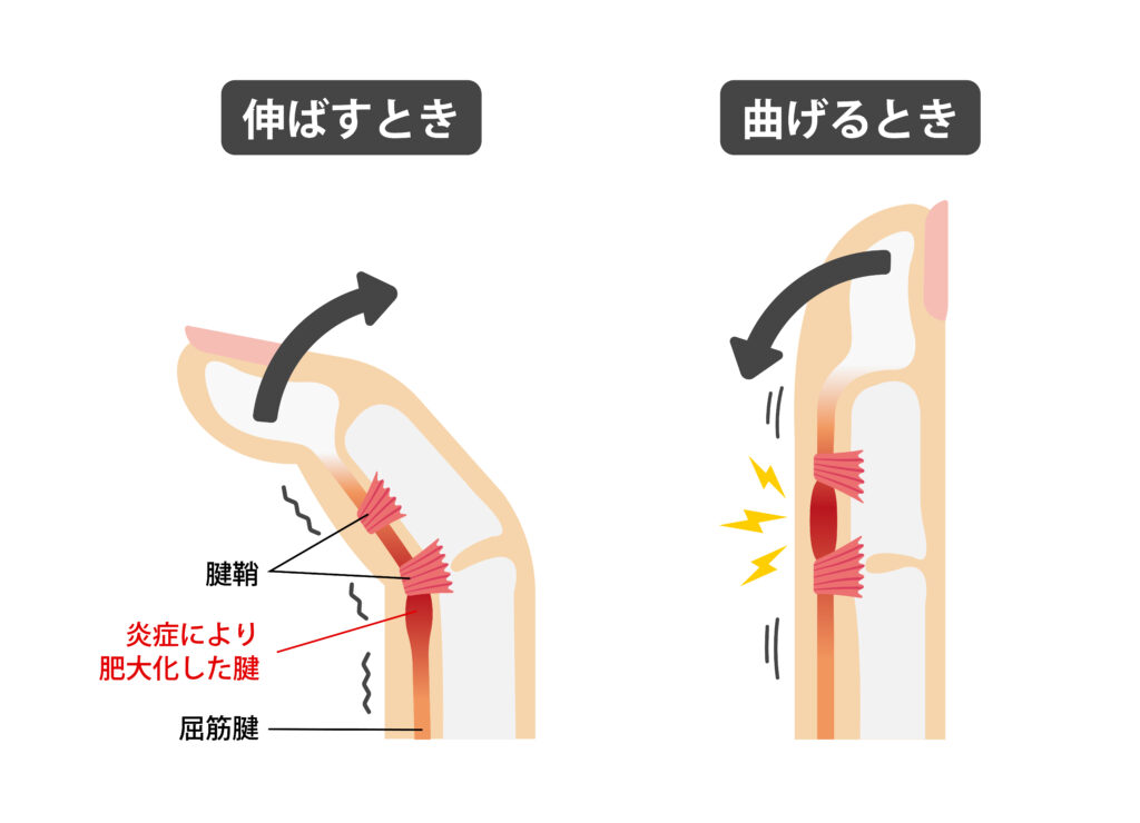 ばね指の原因