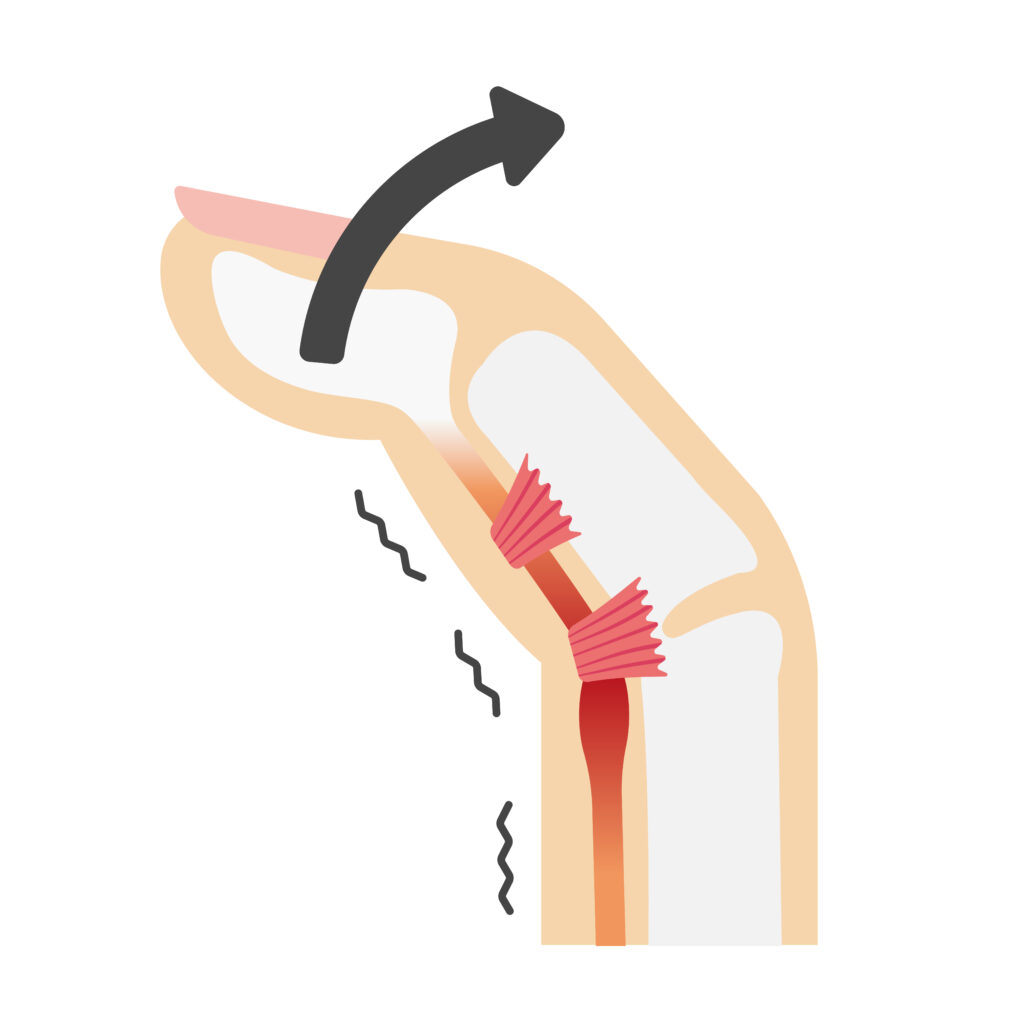 ばね指の専門治療なら松山市の松山はりきゅう接骨院にお任せください！